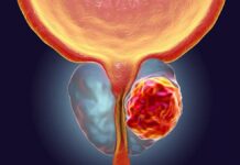 SALUD: El Cáncer de Próstata; cuántos casos se registran al año, edad de mayor riesgo, probabilidad de cura y medidas